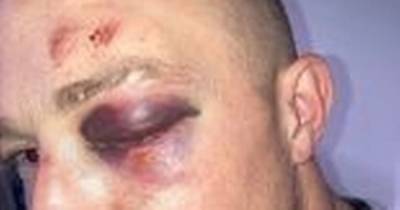 Man left with black eye and bruises after claims he was attacked by GMP officers in his home - www.manchestereveningnews.co.uk - Manchester