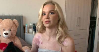 Abbie Quinnen thanks NHS for 'saving' her 8 months after horrific burn accident - www.ok.co.uk