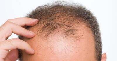 Hair loss appearing in Covid sufferers months after infection - dailyrecord.co.uk - USA - Indiana - Turkey