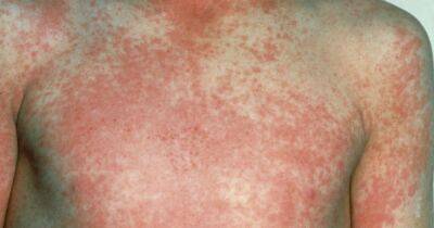 Scarlet Fever outbreak in Scotland prompts fears with cases on the rise - dailyrecord.co.uk - Britain - Scotland