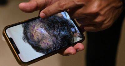 Man dies after botched hair transplant causes head to swell as organs fail - www.dailyrecord.co.uk - India - city New Delhi