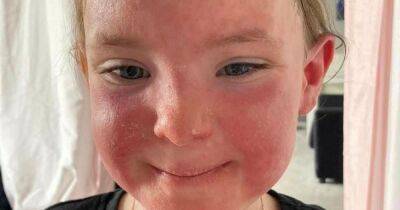 Scots mum warns of Strep A 'sunburn skin' symptom - www.dailyrecord.co.uk - Scotland - city Irvine