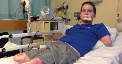 Dad who thought he had 'man flu' loses limbs and part of his face to Strep A - www.dailyrecord.co.uk - Britain