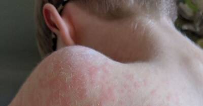 Measles warning and symptoms for children as jab rates at lowest for a decade - www.manchestereveningnews.co.uk - Britain