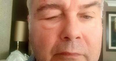 Eamonn Holmes reveals swollen face in snap from shingles battle - www.ok.co.uk