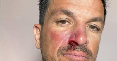Peter Andre shares snap of bruised face and teases 'secret project' - www.ok.co.uk - Australia
