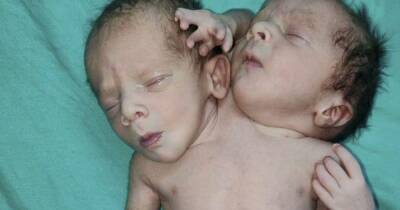Doctors stunned as miracle baby born with two heads, three hands and two hearts - www.dailyrecord.co.uk - India - Syria - city Sana