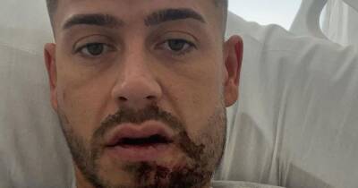 Geordie Shore - Geordie Shore's Ant Kennedy left with broken jaw after 'unprovoked attack' in Ibiza - ok.co.uk - Spain - city San Antonio