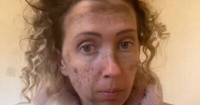 TikTok trend goes horribly wrong for mum trying to create fake freckles - www.dailyrecord.co.uk - Scotland