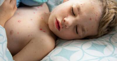Concern raised as scarlet fever and chickenpox cases make 'unprecedented' increase - www.manchestereveningnews.co.uk - county Hall - Manchester - city Wigan, county Hall