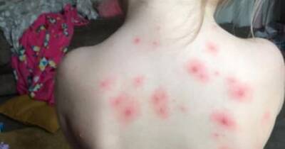 'No more angry red spots' - mum goes viral with remedy for stopping chickenpox itching - www.manchestereveningnews.co.uk