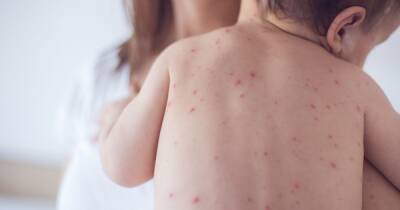 Parents warned over 'highly infectious' scarlet fever and chicken pox as cases rise - www.dailyrecord.co.uk - Britain