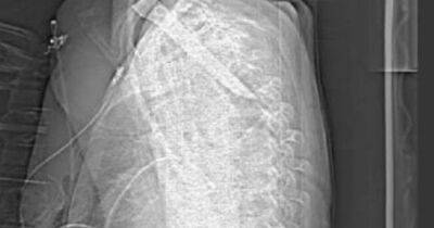 Shocking X-ray shows five-inch knife lodged in base of man's neck - manchestereveningnews.co.uk - Manchester - county Durham