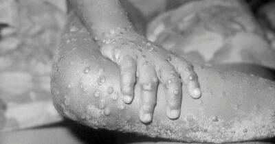Susan Hopkins - Monkeypox rules, symptoms, and risks as UK cases rise to 57 - dailyrecord.co.uk - Britain - Scotland - Belgium