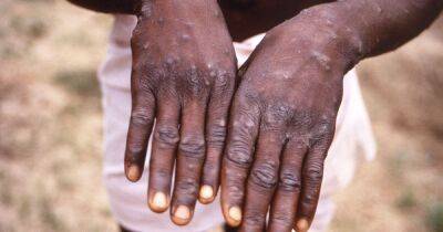 Another 14 cases of monkeypox confirmed in England as UK total rises to 71 - www.manchestereveningnews.co.uk - Britain - Spain - Scotland - Ireland - Portugal - Nigeria
