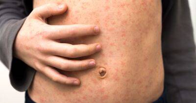 Measles outbreak: The five 'serious' symptoms for parents to look out for - www.dailyrecord.co.uk - Britain