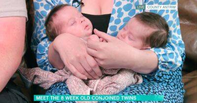 Parents welcome 'miracle' conjoined twins who are one in 2.5 million - www.dailyrecord.co.uk - Ireland