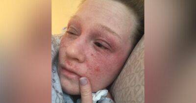 Woman, 22, left with 'oozing' skin and hair 'falling out' after using eczema cream - www.manchestereveningnews.co.uk - Manchester