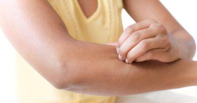 Tips to avoid eczema flare-ups in the sun during UK heatwave - ok.co.uk - Britain