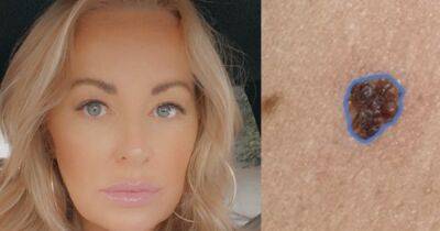 Scots mum 'diagnosed' own with skin cancer with app from smartphone - dailyrecord.co.uk - Scotland - USA