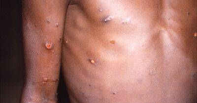 77 more monkeypox cases detected bringing UK total to 302 - www.manchestereveningnews.co.uk - Britain - Scotland