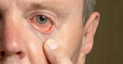 High cholesterol symptoms that appear around your eyes - including skin bumps - www.dailyrecord.co.uk