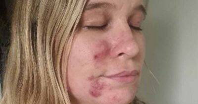 Mum felt 'like a monster' and hid her face from daughter when struck with cystic acne after Covid - manchestereveningnews.co.uk - Manchester