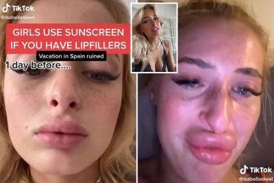 Tiktok - My lip fillers blew up after bad reaction to sunlight: Use sunscreen! - nypost.com - Spain