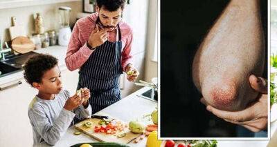 Psoriasis: The best type of food to alleviate condition - symptoms to spot - www.msn.com - Britain
