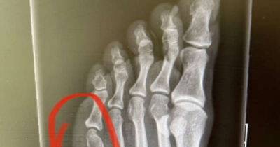 Coleen Rooney - Rebekah Vardy - Wayne Rooney - Jamie Vardy - Coleen Rooney shares broken toe X-ray after claims she was ‘milking’ court moon-boot - msn.com