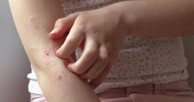 New eczema drug therapy 'highly effective' for young children - dailyrecord.co.uk - Britain - USA - Manchester