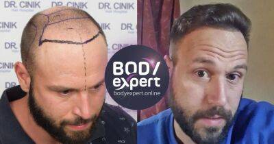 A hair transplant in Turkey could help with hair loss issues - manchestereveningnews.co.uk - Turkey - city Istanbul, Turkey