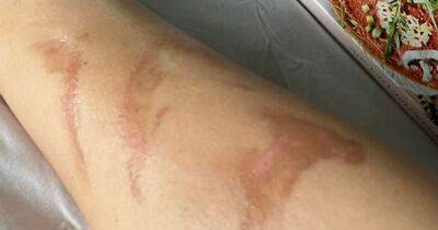 Traveller issues warning about surprise burn marks that can take years to heal - dailyrecord.co.uk - Australia - Indonesia