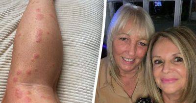 Woman fears 200 bed bug bites on her face and arms 'might never go away' after night in Blackpool hotel - www.manchestereveningnews.co.uk - Paris