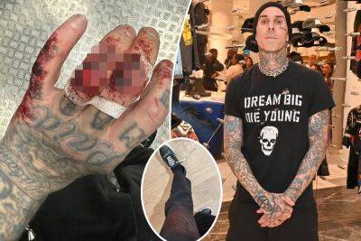 Travis Barker shows off bloody, gory hand injury after Blink-182 concert in England - nypost.com - Italy - Manchester