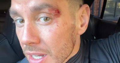 Scott Thomas shows off bloodied face and reveals injuries after nasty sports accident - www.ok.co.uk - London - Manchester