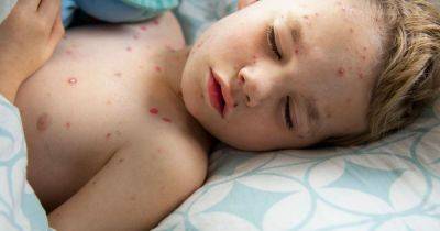 Chickenpox vaccine should be introduced on NHS for children, scientists say - www.manchestereveningnews.co.uk - Australia - Britain - USA - Manchester - Dubai