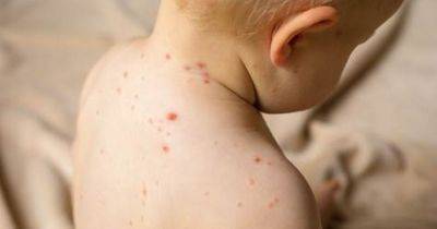Doctors' measles warning amid 'devastating resurgence' - see the outbreaks where you live - www.manchestereveningnews.co.uk - Britain - London - Birmingham