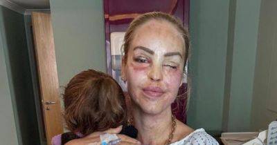 Loose Women's Katie Piper asks 'please don't troll me' as she shares post-surgery images trying to save eye - www.manchestereveningnews.co.uk - Manchester