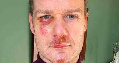 Dan Walker inundated with messages over healed face as he steps out after accident - www.msn.com - city Sheffield