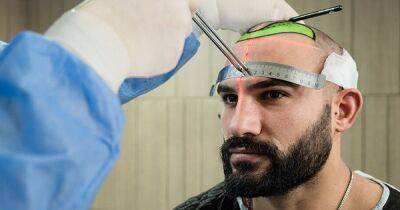 NIH's recommended hair transplant clinics in Turkey to research in 2023 - www.manchestereveningnews.co.uk - Britain - Turkey