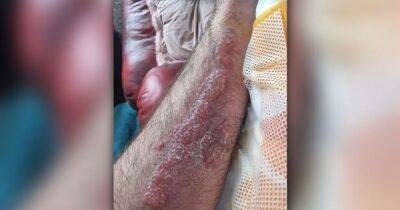 Man's urgent warning after hair dye patch test leaves arms red and blistered in extreme reaction that 'could've put him in coma' - www.manchestereveningnews.co.uk