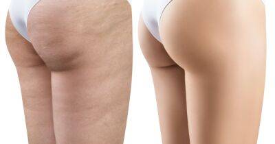 10 Best Butt and Thigh Cellulite Solutions for Real Results - www.usmagazine.com