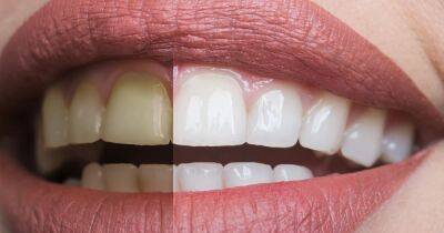 Whiter Teeth in 15 Seconds! Shop This $20 Color-Correcting Treatment on Prime - www.usmagazine.com