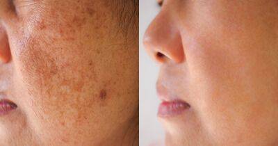 90% of Users Saw a Reduction in Their Dark Spots With This Serum - www.usmagazine.com
