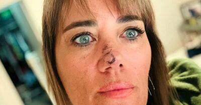 Woman diagnosed with skin cancer after covering spot on nose with concealer for months - www.dailyrecord.co.uk - New Zealand