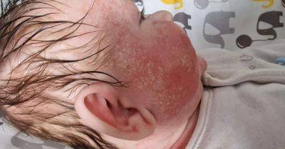 Mum-of-seven's despair as baby born 'with skin like a snake' - and eczema treatments only made swelling worse - www.manchestereveningnews.co.uk