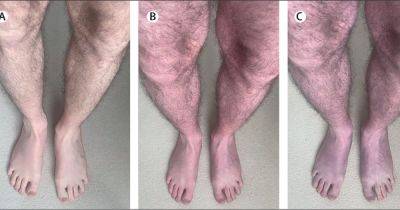 Rare Long Covid symptom identified as man's legs turn purple after standing up - www.dailyrecord.co.uk