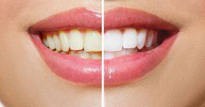 9 Shades Lighter in 1 Week! This LED Teeth Whitening Kit Is 52% Off - www.usmagazine.com