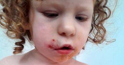 "The dog's got away with it": Girl, four, 'scarred for life' after terrier bites her cheek in park - www.manchestereveningnews.co.uk - county Nelson
